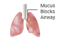 mucus blocks airway icon