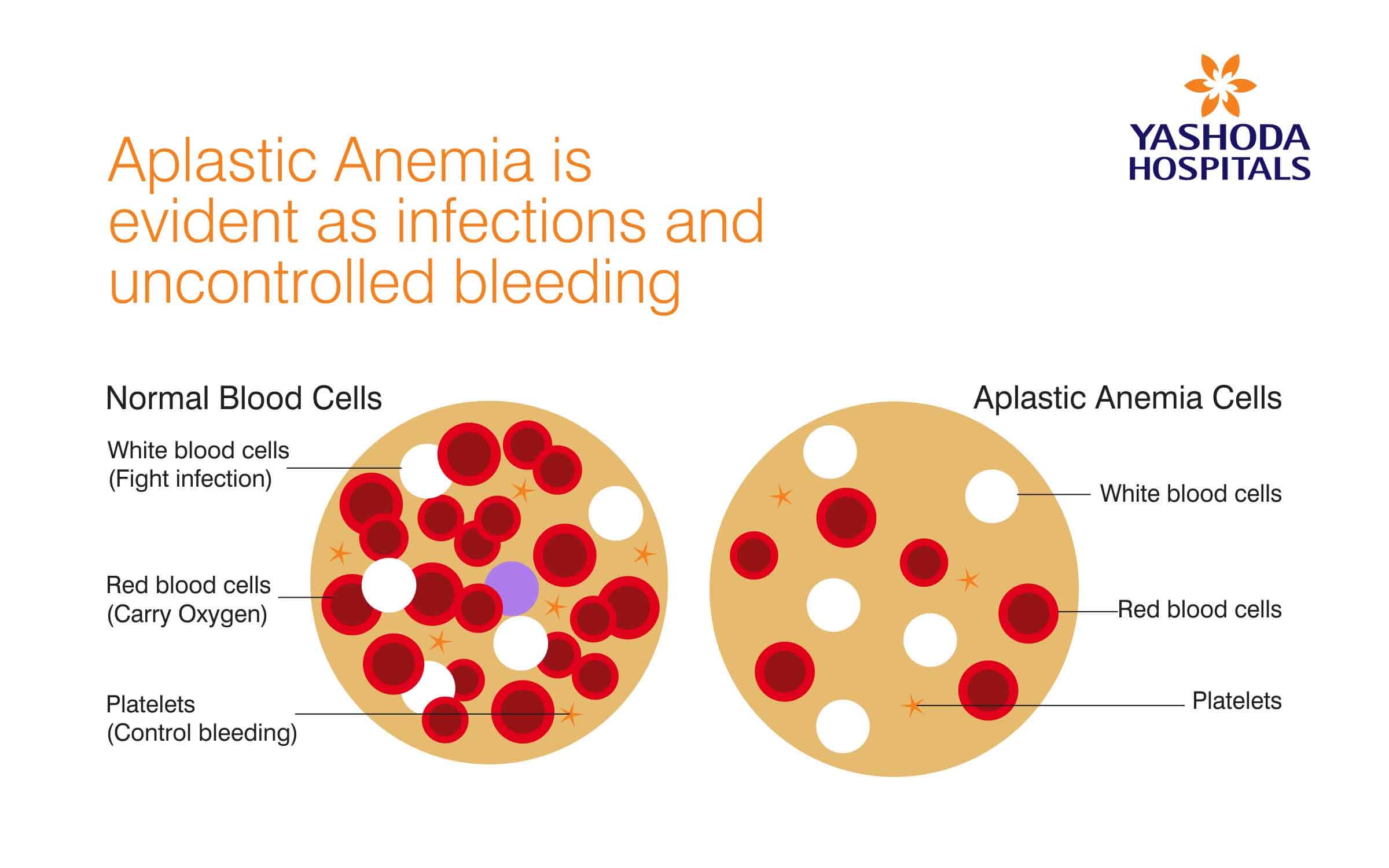 Aplastic Anemia is evident as infections and uncontrolled bleeding.