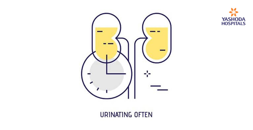 Urinary incontinence in bladder cancer