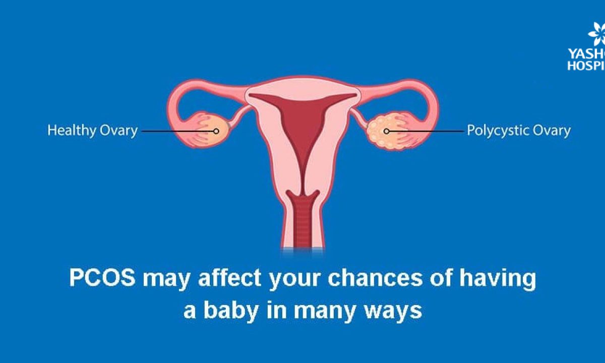 Polycystic Ovary Syndrome Pcos Causes Symptoms