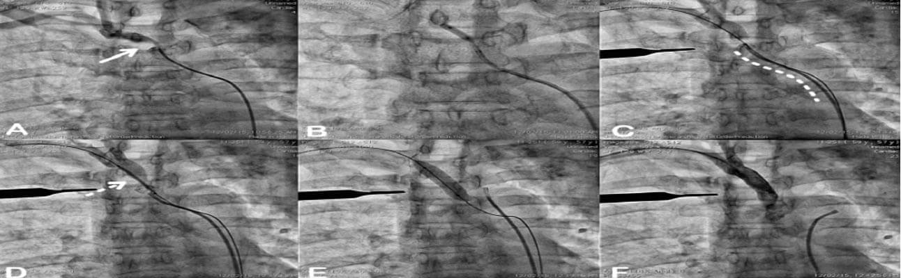 combined approach for Right innominate artery PTA combined approach for Right innominate artery PTA
