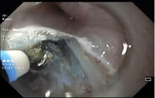 Peroral endoscopic Myotomy (POEM) - Mucosal incision Peroral endoscopic Myotomy (POEM) - Achalasia Cardia