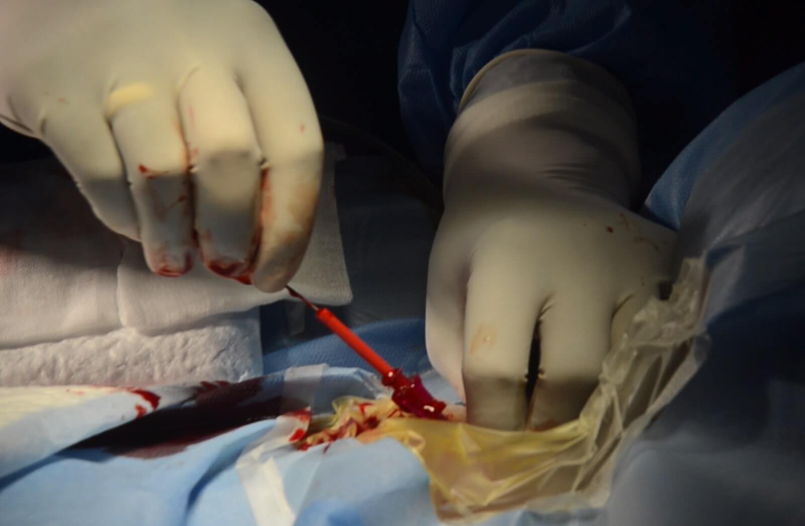 Uterine artery embolization