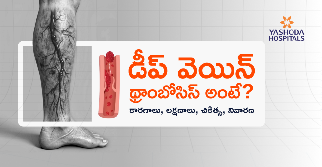 deep-vein-thrombosis