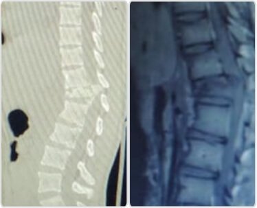 Pre op CT and MRI images showing unstable D12 burst fracture with retropulsion of fragment compromising the cord