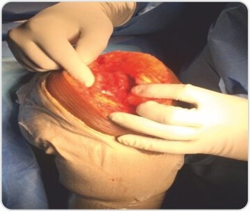 Distal Femoral Replacement for Severe Osteoarthritis Knee With Osteoporotic Distal Femoral Fracture