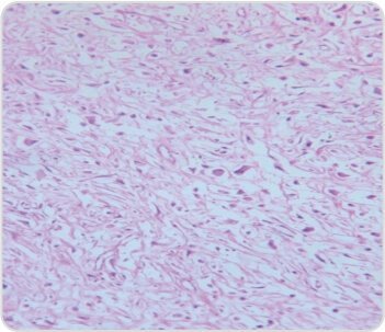 Paratesticular Tumor Leiomyosarcoma