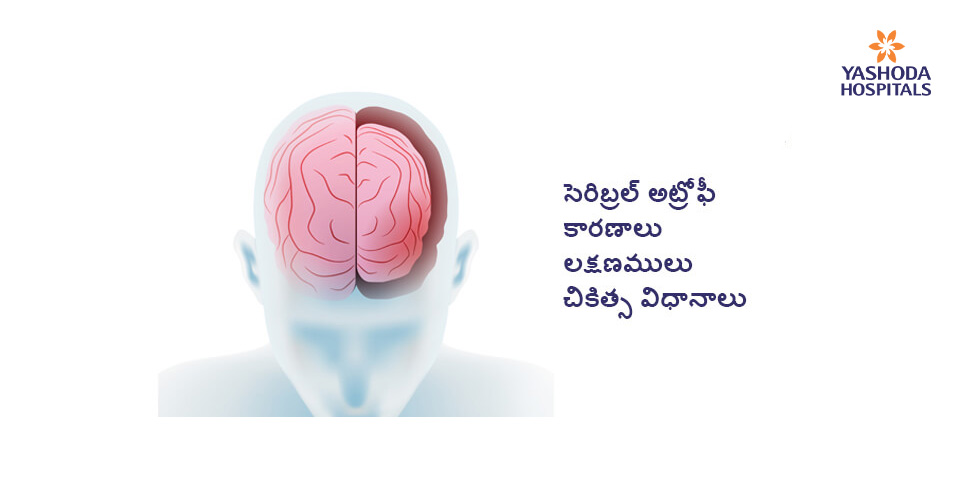 సెరిబ్రల్ అట్రోఫీ- కారణాలు-లక్షణములు-చికిత్స విధానాలు