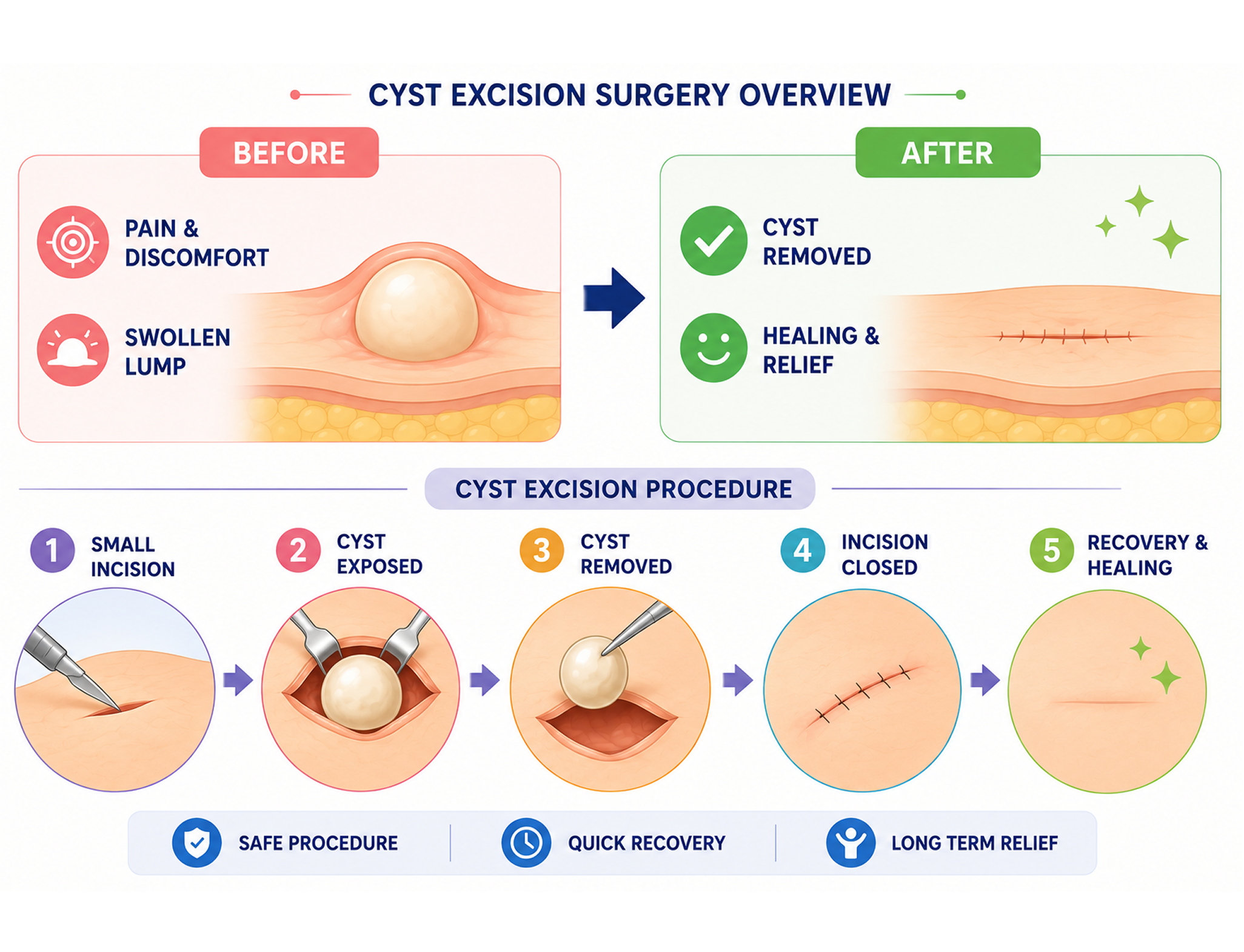 cyst excision
