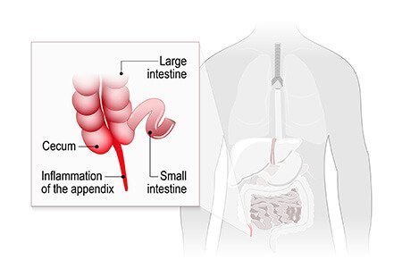 tirzepatide appendicitis Appendicitis: Causes, Symptoms, Early Signs, Recovery and Treatment