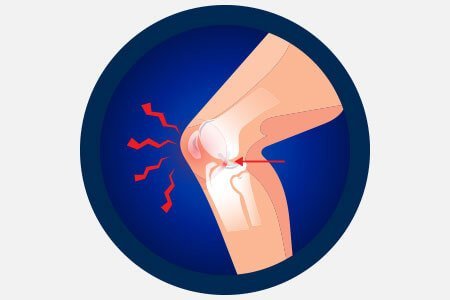 ACL Injury