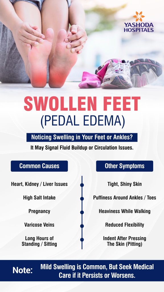swollen-feet