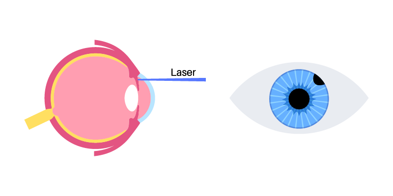 Web Banner_- YAG PI (Peripheral Iridotomy) Laser