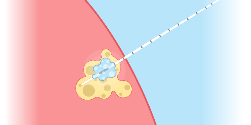 Web Banner_Cryoablation