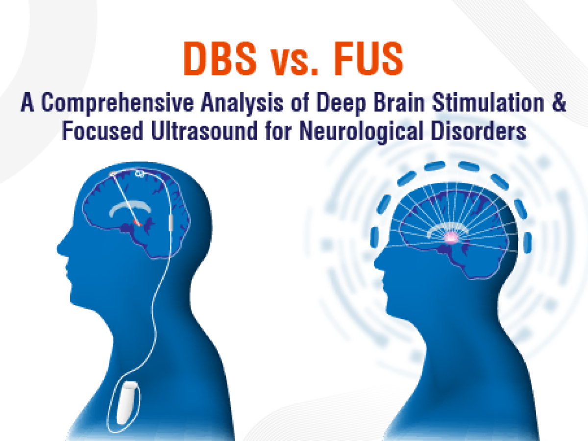 DBS vs. Focused Ultrasound: Treating Neurological Disorders