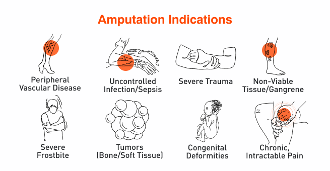 Amputation