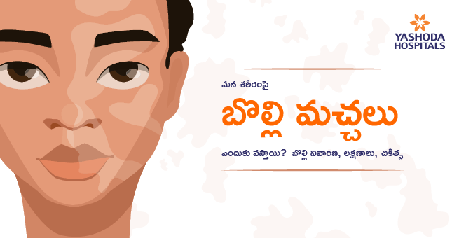 Vitiligo Main bannet telugu