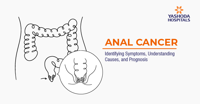 Anal Cancer Main Banner