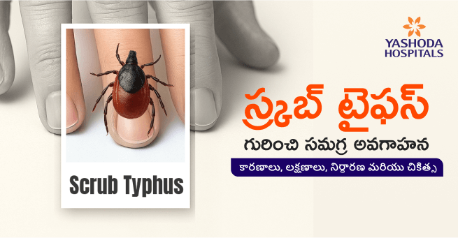 Scrub typhus Main Banner