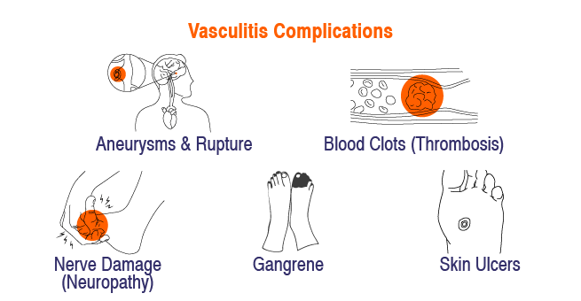 Vasculitis
