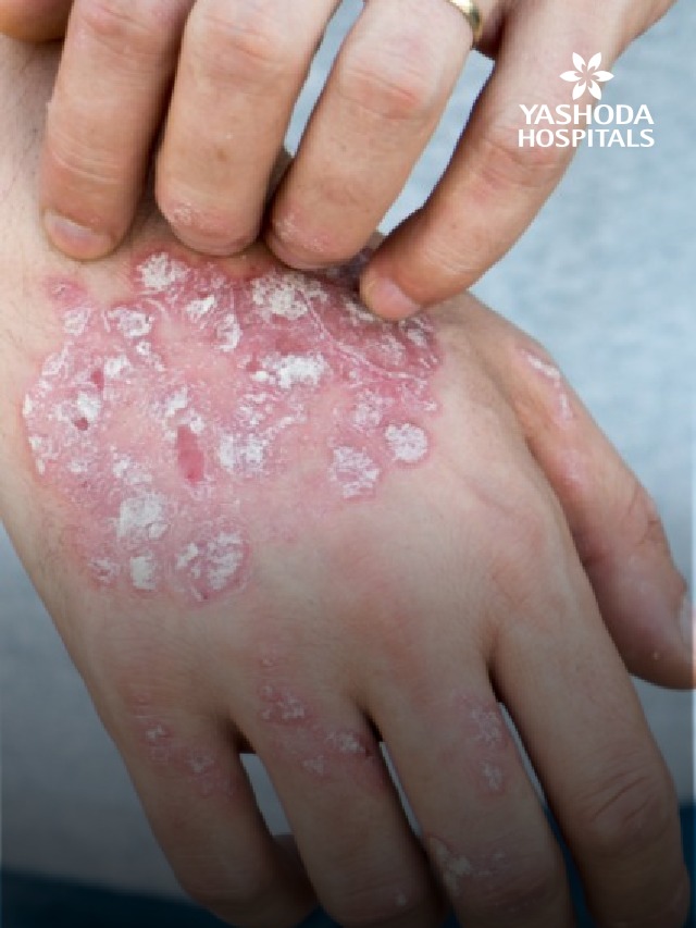 Daily Life With an Autoimmune Condition