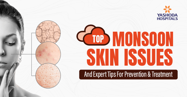 Common Monsoon Skin Diseases_Main (1)