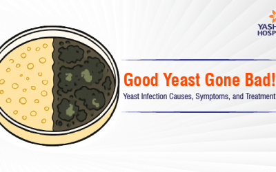 Good Yeast Gone Bad! Yeast Infection Causes, Symptoms, and Treatment