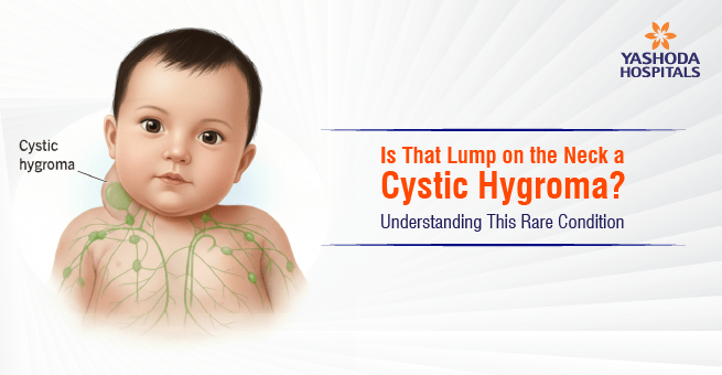 Is That Lump On Neck Cystic Hygroma Main Banner