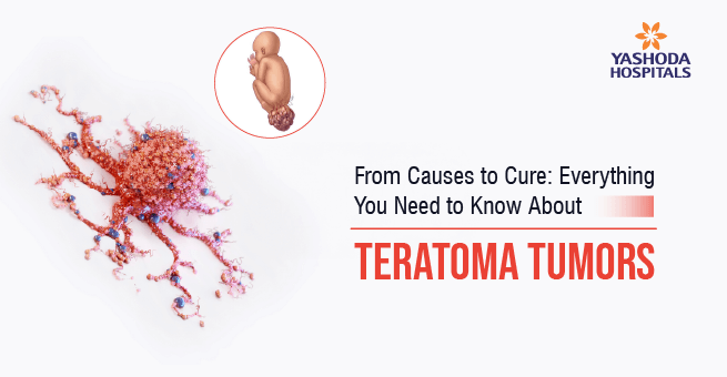 Teratoma Tumors Main Banner