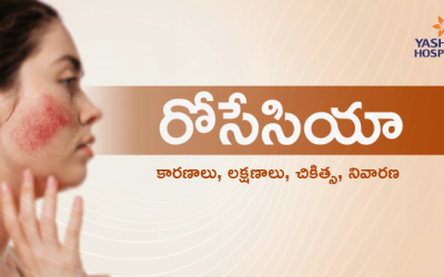 రోసేసియా : కారణాలు, లక్షణాలు, చికిత్స, నివారణ