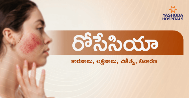 Rosacea Telugu Main Banner