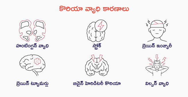 chorea-disease-body
