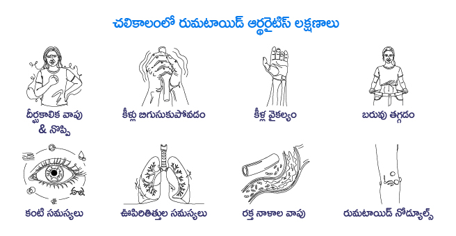rheumatoid-arthritis