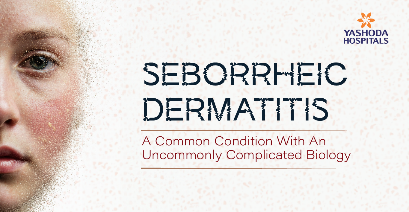 seborrheic-dermatitis-main