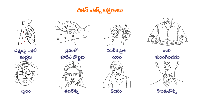 chickenpox