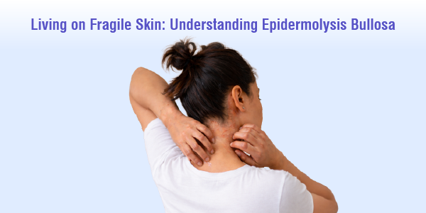 living-on-fragile-skin