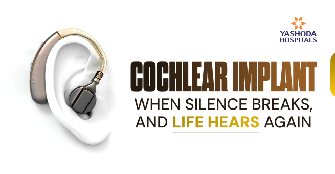 cochlear-implant