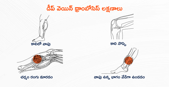 deep-vein-thrombosis