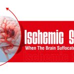 ischemic-stroke-1.jpg