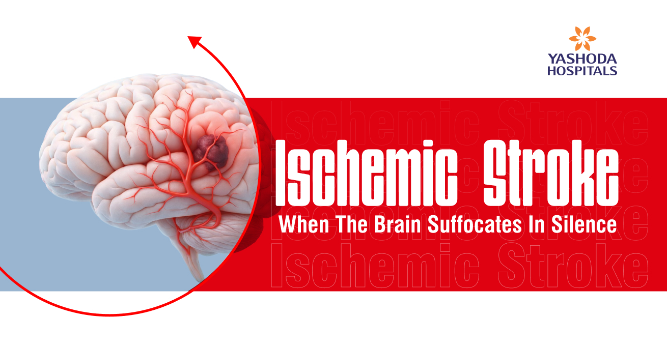 ischemic-stroke-1.jpg