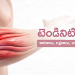 tendinitis-telugu