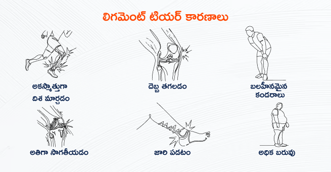 ligament-tear-causes