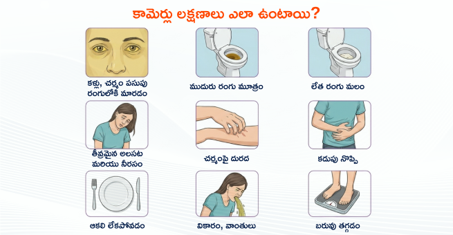 Jaundice-symptoms