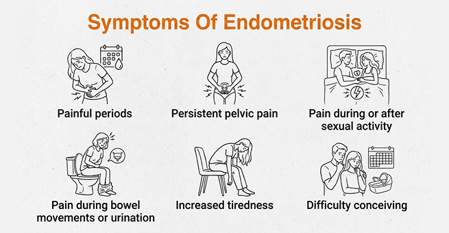 Endometriosis -symptoms
