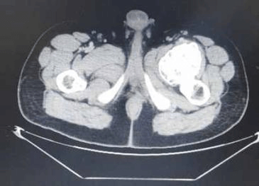 3D CT Scan