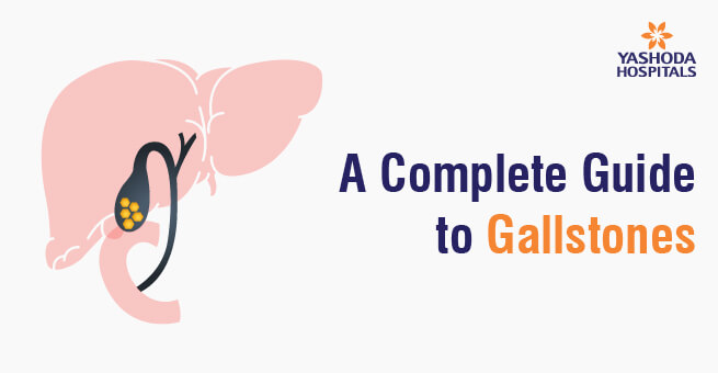A Complete Guide to Gallstones