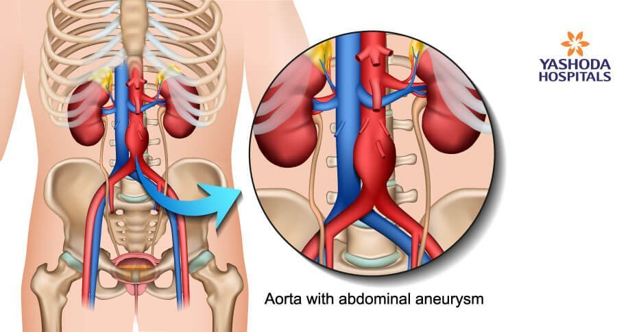 Abdominal aortic aneurysm causes and treatment