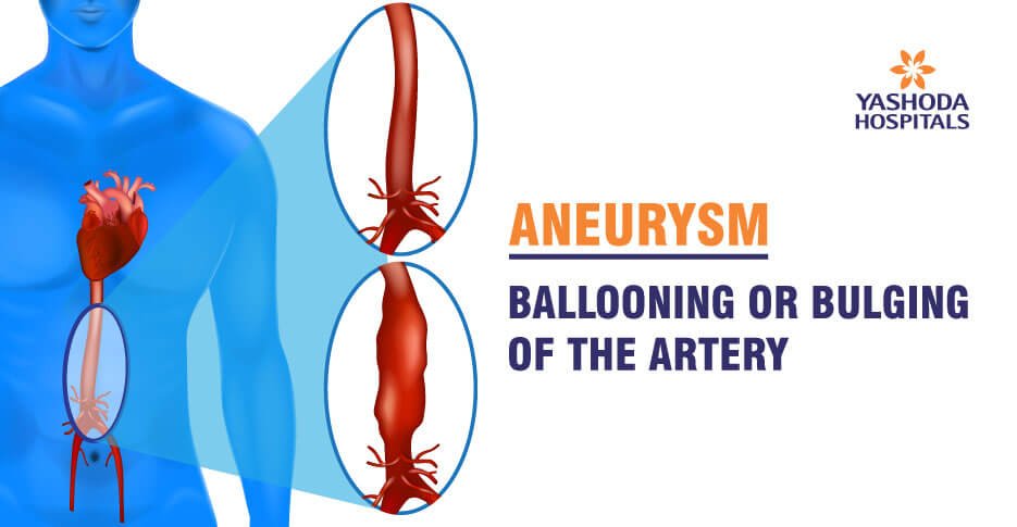 Aneurysm types, causes, diagnosis, treatment
