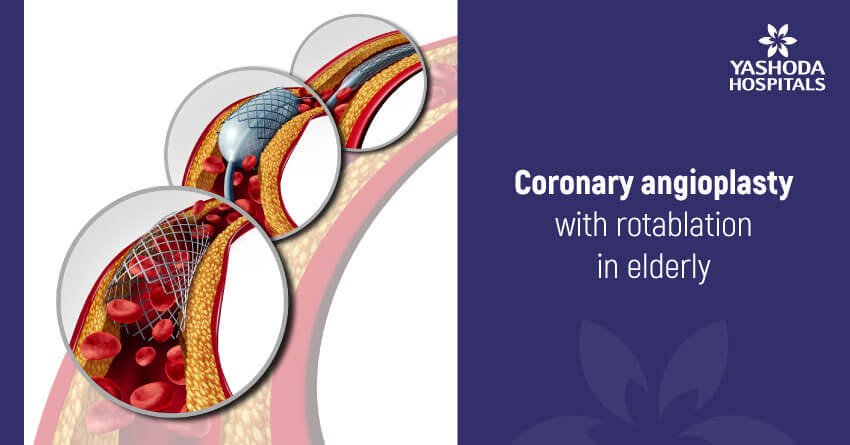 Coronary angioplasty with rotablation in elderly