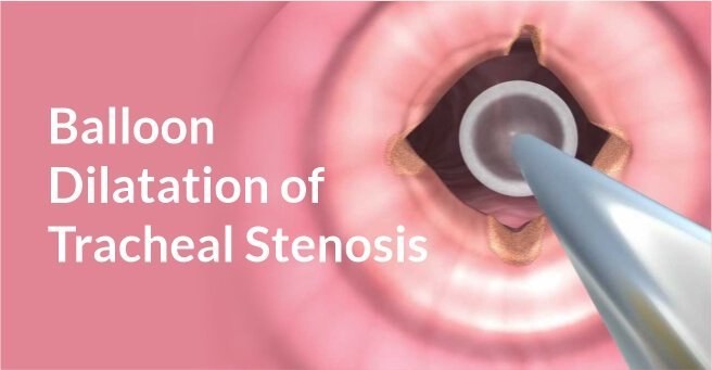Balloon Dilatation of Tracheal Stenosis